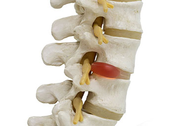 Image of Herniated dsic