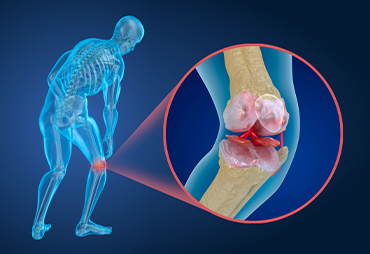 Diagram of joint with osteoporosis