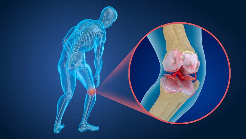 Diagram of knee joint with osteoporosis