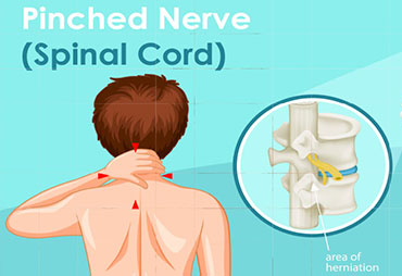 Digram of pinched nerve in spinal cord